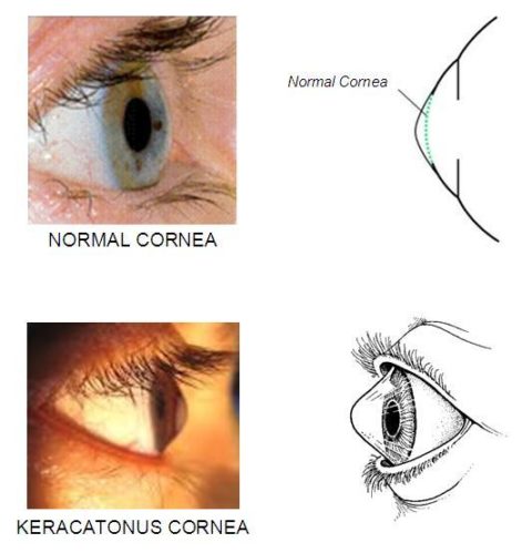 Keratoconus - barryandsargent.co.nz